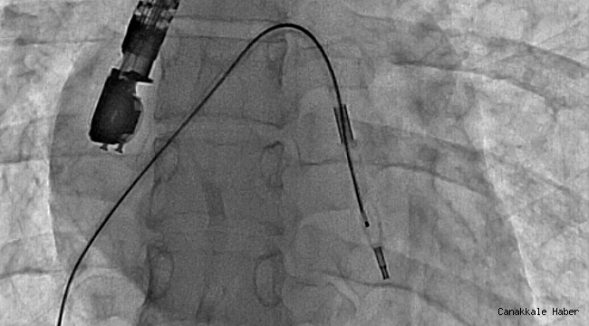 Mitral balon operasyonu adım adım kaydedildi
