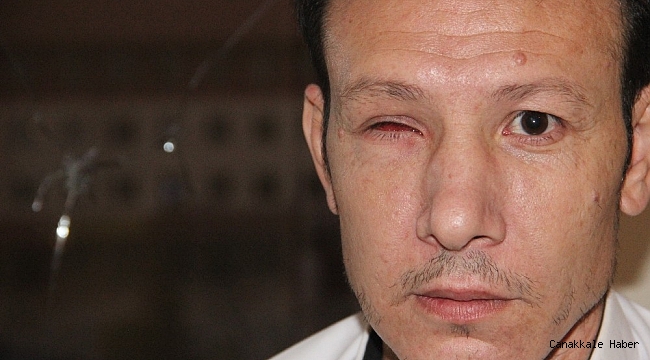 Pencereden baktı, bir gözünü kaybetti