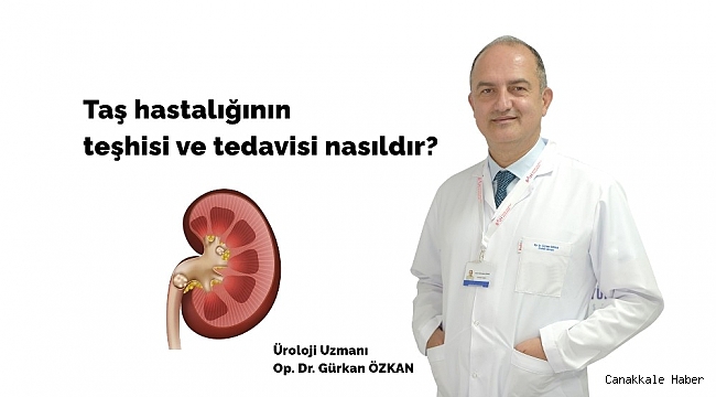 Taş hastalığına ses dalgası ve lazer çözümü