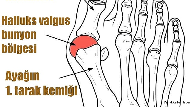 Dar ve sivri burunlu ayakkabılar şekil bozukluğuna sebep oluyor