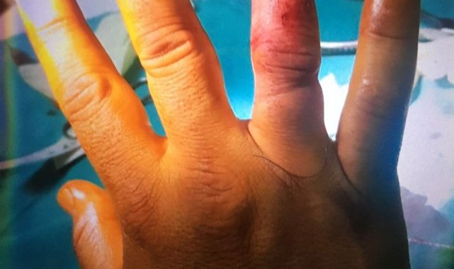 Gece kulübüne alınmayan kadın, güvenlik görevlisinin parmağını kopardı