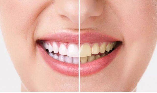 Bilinçsiz yapılan dişlerde ağartma işlemi kalıcı hasarlara neden oluyor
