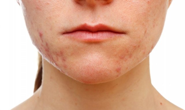 Cildinizi &#039;maskne&#039;ye karşı korumanız mümkün