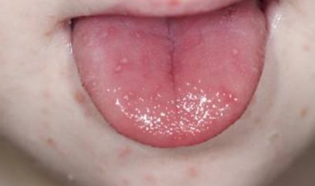 Sıcaklığın artmasıyla birlikte bu hastalıkta da artış yaşanıyor