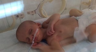 MHP ve AK Parti, doğuştan dudakları yapışık olan Umut bebek için seferber oldu